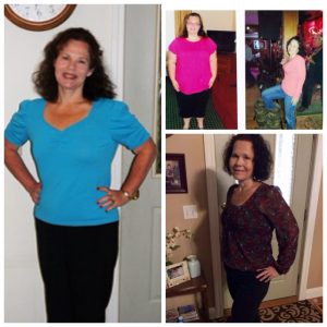 Lesa Brune Before & After Mini-Gastric Bypass